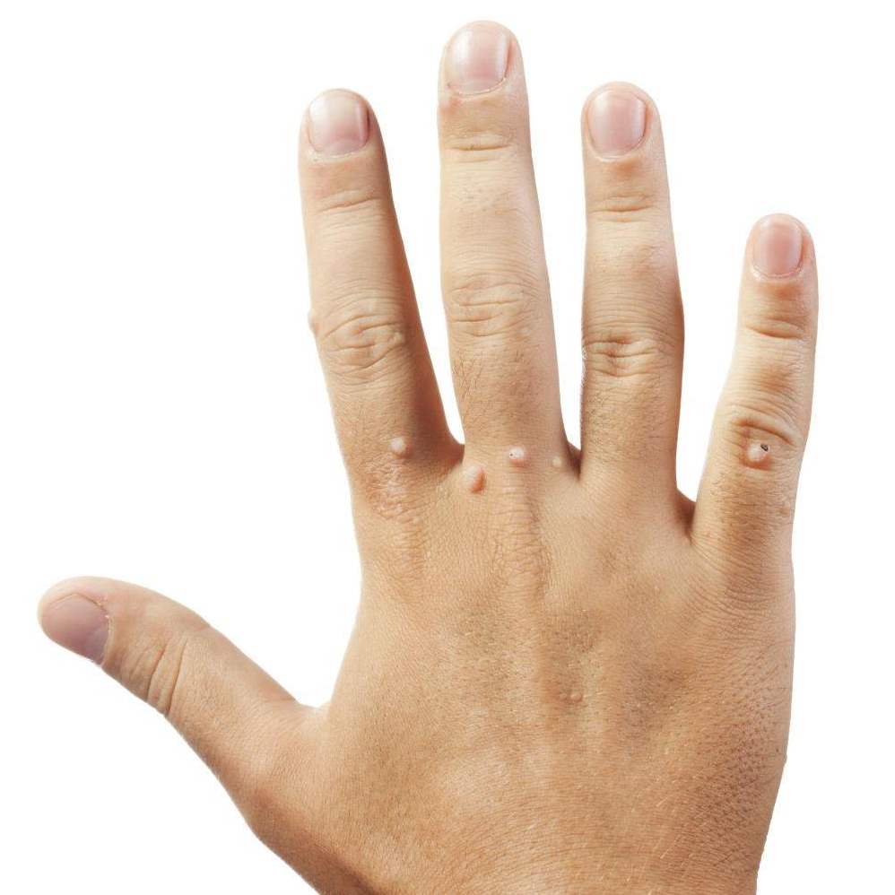 Бородавки у детей