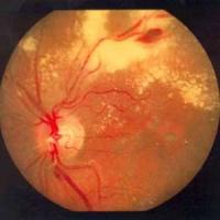 как лечить ретинопатию