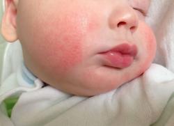 диатез на щеках у ребенка