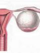 Эндометриоидная киста яичника – все возможные методы лечения