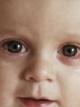 Красные глаза у ребенка